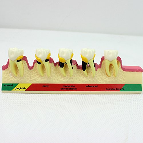 Doktor.Kraliyet Periodontal Hastalık Ayırmak Diş Typodont Çalışma Öğretim Diş Modeli